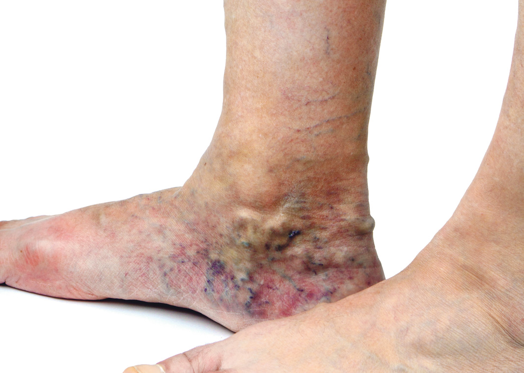 Cómo saber si tiene venas varicosas Qué Pasa