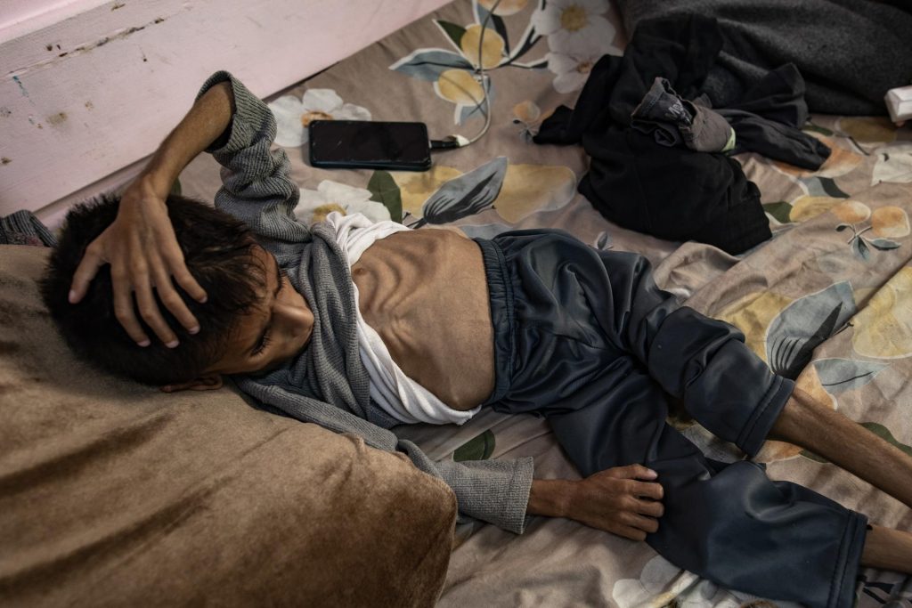 Un niño palestino de cinco años, que sufre de desnutrición severa, recibe tratamiento en el Hospital Al Nasser en Jan Yunis, en el sur de la Franja de Gaza, el 26 de mayo de 2025. EFE/EPA/HAITHAM IMAD